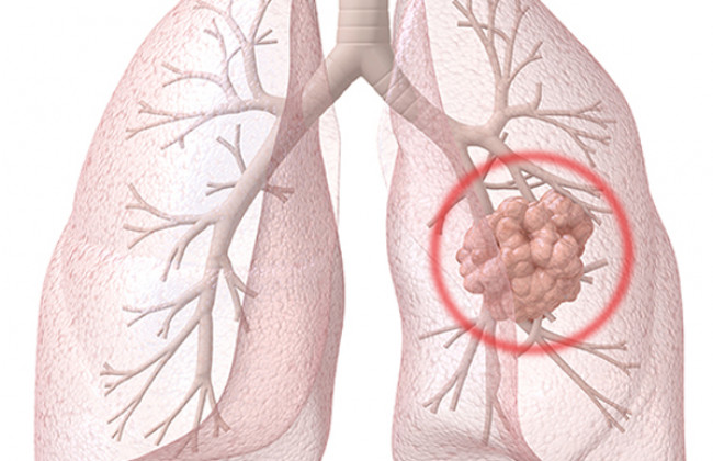 Image What is Lung Cancer? | Types of Lung Cancer |  Symptoms and causes