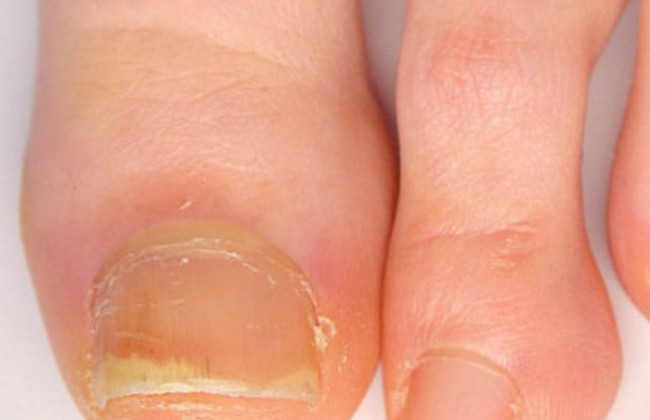 Image नाखून सोरायसिस क्या है? कारण, लक्षण और इलाज | Nail Psoriasis in Hindi