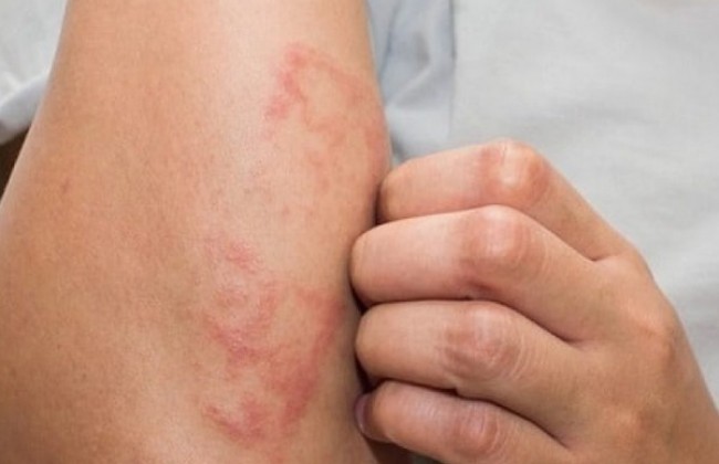 स्केबीज क्या है? कारण, लक्षण और इलाज | Scabies in Hindi