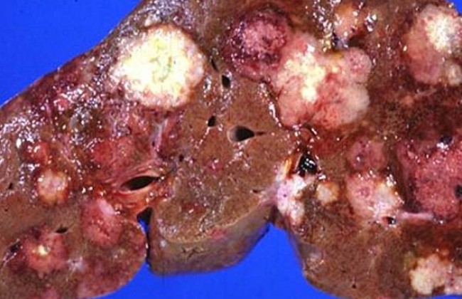 Image Liver Disorders in India: Understanding the Prevalence