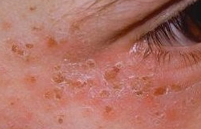 पोर्फिरीया क्या है? कारण, लक्षण और इलाज | What is Porphyria in Hindi