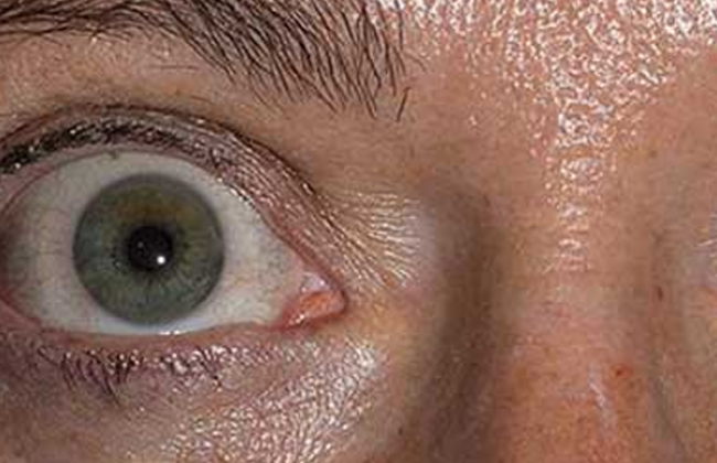थायराइड नेत्र रोग क्या है? कारण, लक्षण और इलाज | What is Thyroid Eye Disease in Hindi