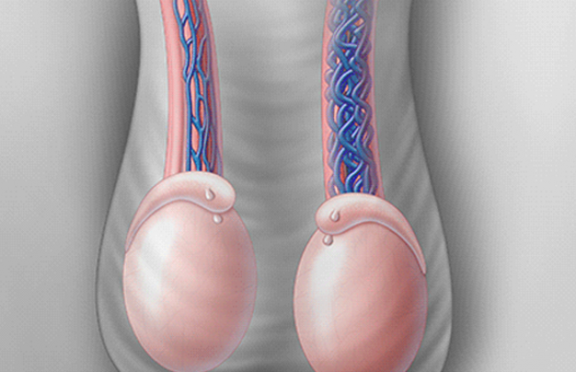 वैरिकोसेले क्या है? कारण, लक्षण और इलाज | What is Varicocele in Hindi