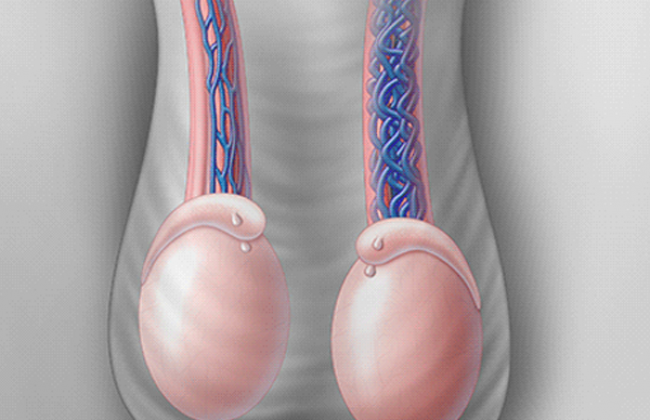 Image वैरिकोसेले क्या है? कारण, लक्षण और इलाज | What is Varicocele in Hindi