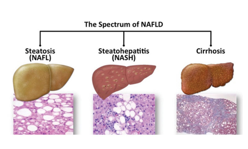 Non-Alcoholic Fatty Liver Disease