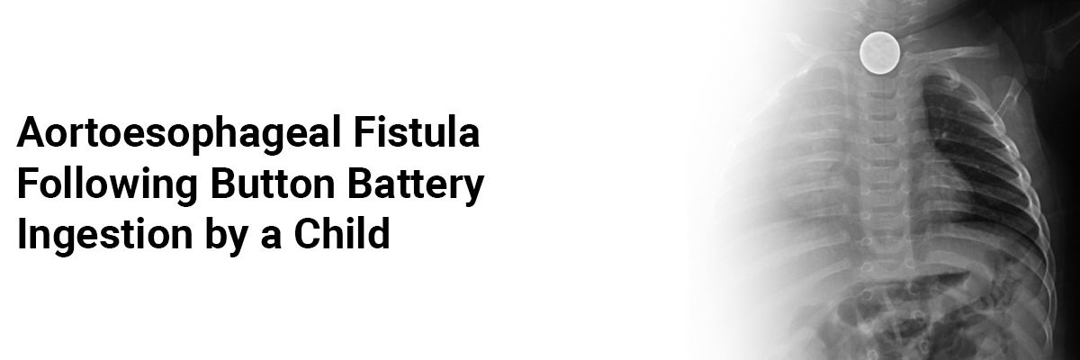 Aortoesophageal Fistula Following Button Battery Ingestion by a Child