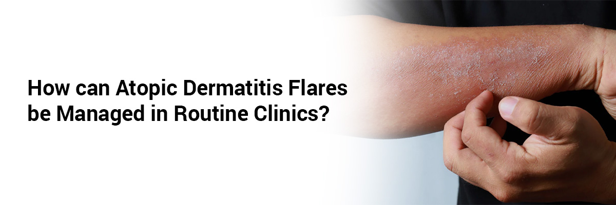 How can Atopic Dermatitis Flares be Managed in Routine Clinics?