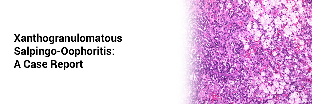 Xanthogranulomatous Salpingo-oophoritis: A case report
