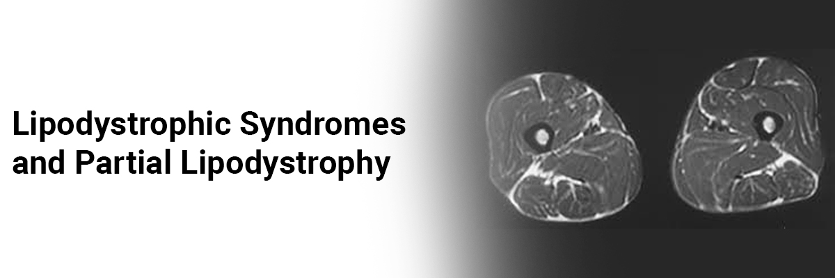Lipodystrophic syndromes and Partial lipodystrophy