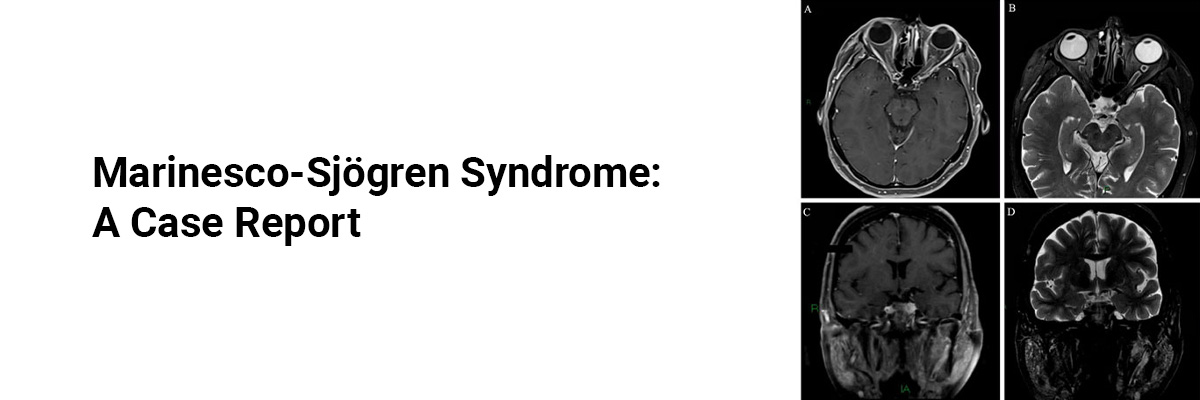 Marinesco-Sjögren Syndrome: A Case Report