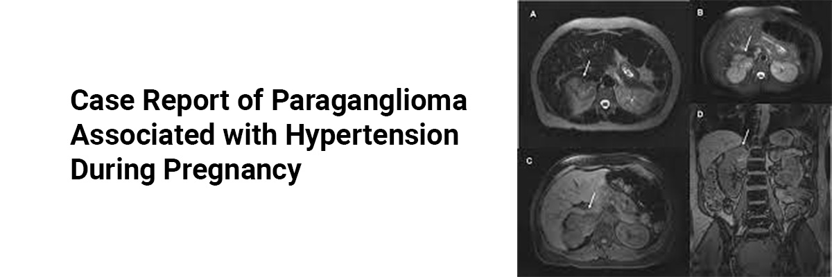 Case Report of Paraganglioma Associated with Hypertension During Pregnancy
