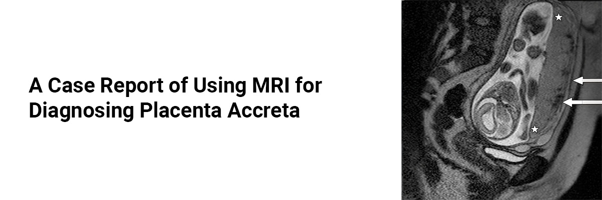 A Case Report of Using MRI for Diagnosing Placenta Accreta