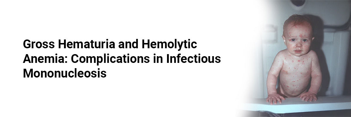 Gross Hematuria and Hemolytic Anemia: Complications in Infectious Mononucleosis
