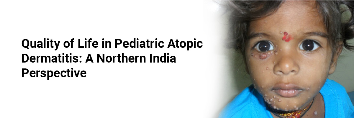Quality of Life in Pediatric Atopic Dermatitis: A Northern India Perspective