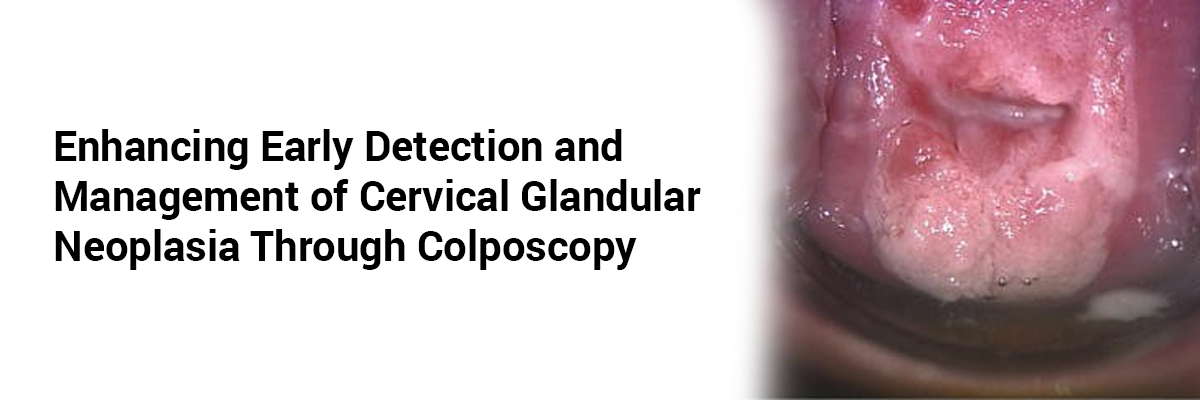 Enhancing Early Detection and Management of Cervical Glandular Neoplasia Through Colposcopy 