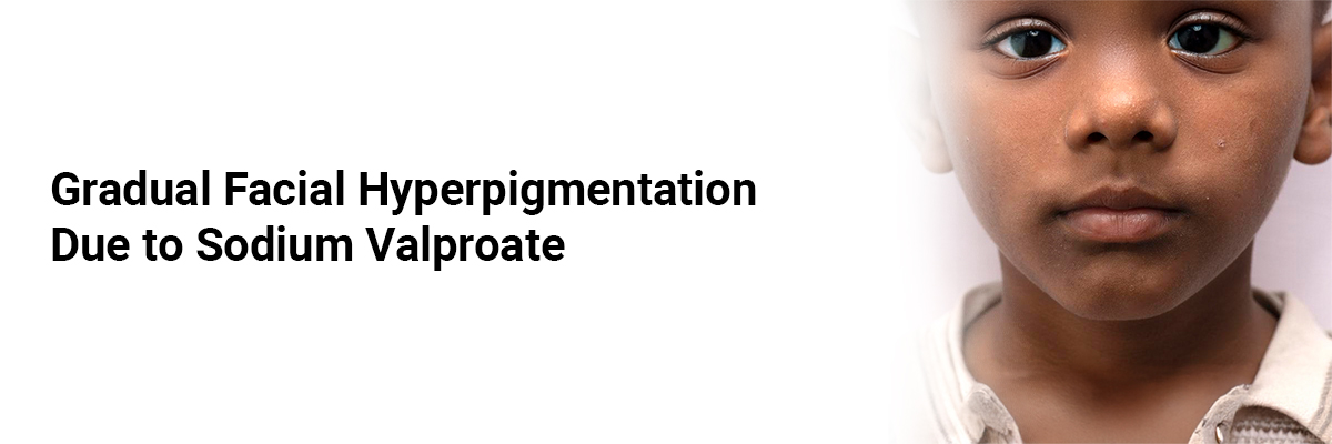 Gradual Facial Hyperpigmentation Due to Sodium Valproate 