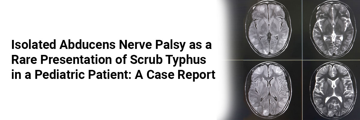 Isolated Abducens Nerve Palsy as a Rare Presentation of Scrub Typhus in a Pediatric Patient: A Case Report