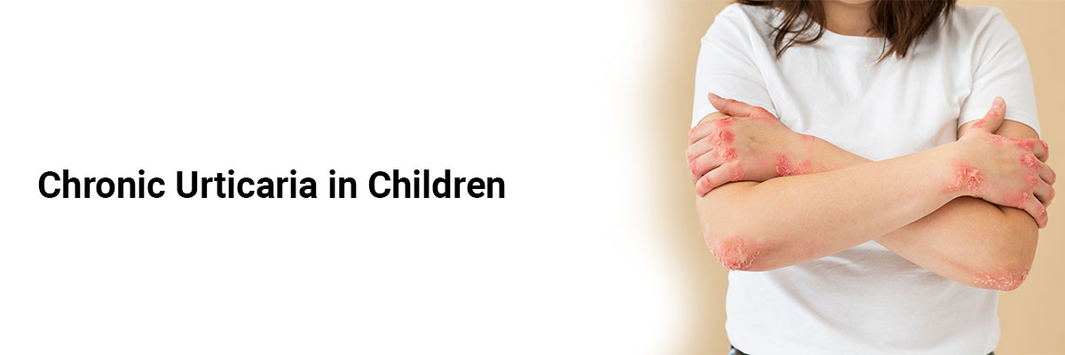 Chronic Urticaria in Children