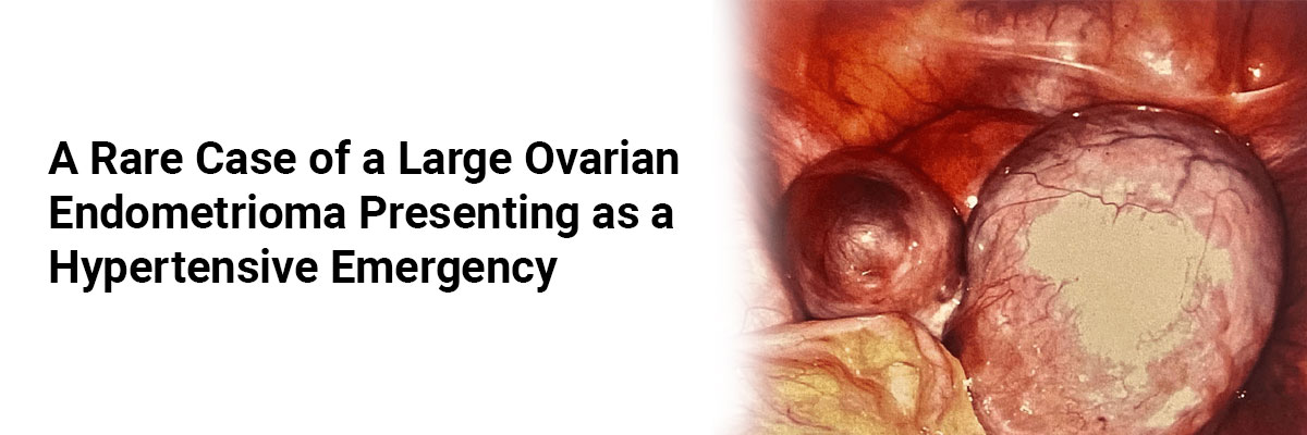 A Rare Case of a Large Ovarian Endometrioma Presenting as a Hypertensive Emergency