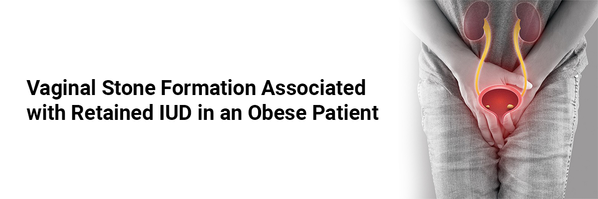 Vaginal Stone Formation Associated with Retained IUD in an Obese Patient