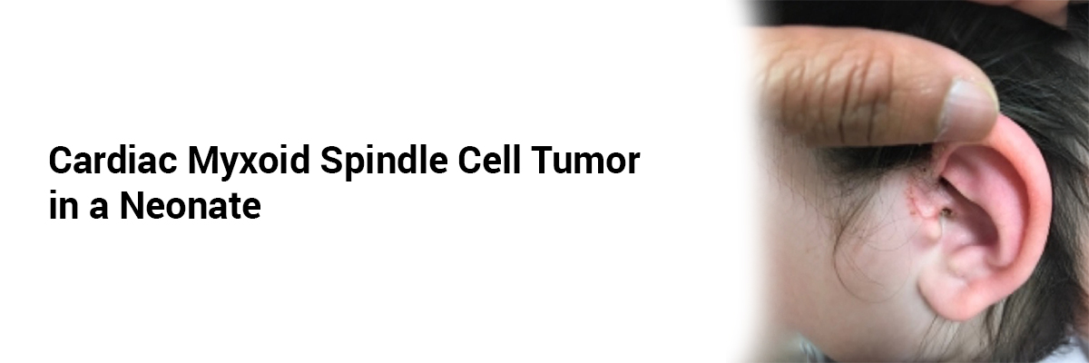 Cardiac Myxoid Spindle Cell Tumor in a Neonate