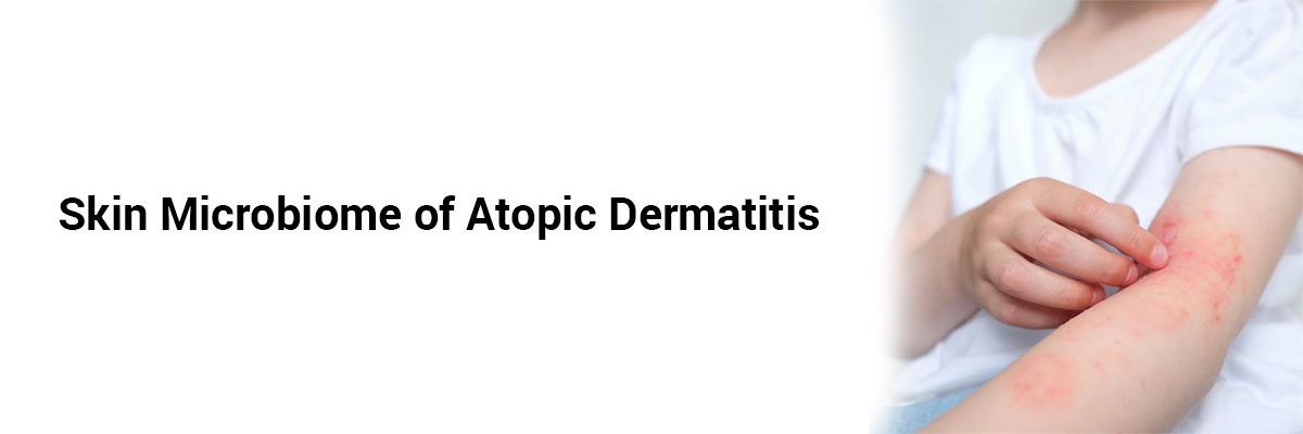 Skin Microbiome of Atopic Dermatitis