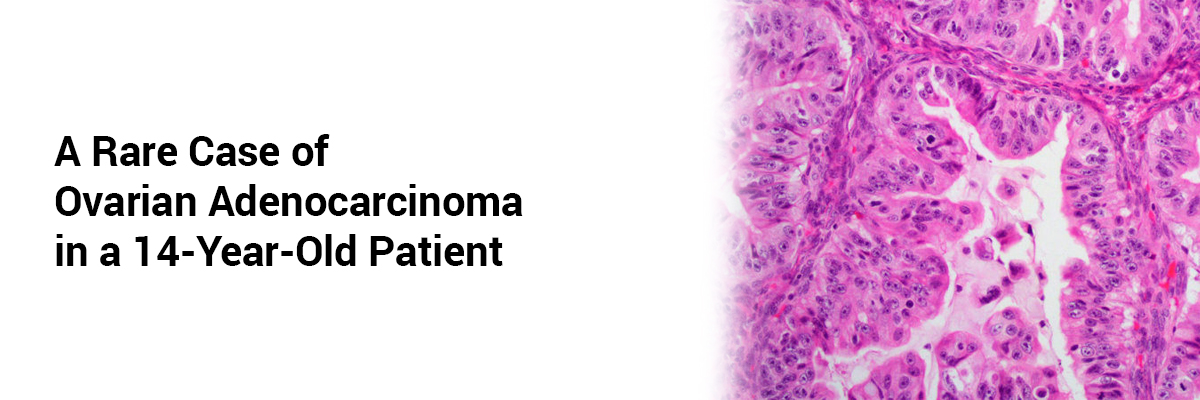 A Rare Case of Ovarian Adenocarcinoma in a 14-Year-Old Patient