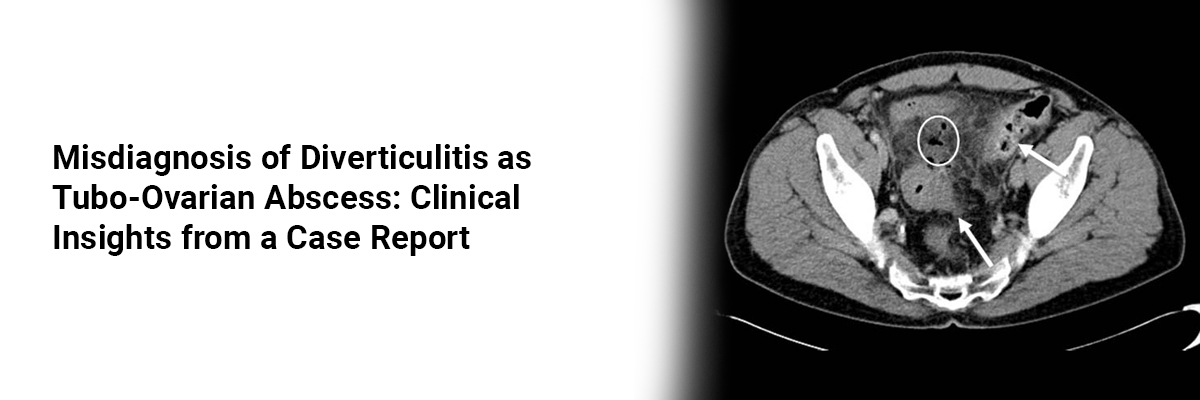 Misdiagnosis of Diverticulitis as Tubo-Ovarian Abscess: Clinical Insights from a Case Report