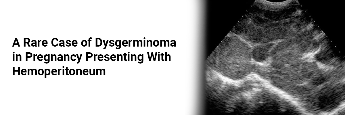 A Rare Case of Dysgerminoma in Pregnancy Presenting with Hemoperitoneum