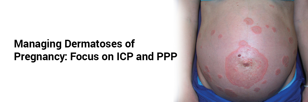 Managing Dermatoses of Pregnancy: Focus on ICP and PPP