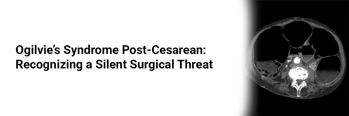 Ogilvie’s Syndrome Post-Cesarean: Recognizing a Silent Surgical Threat
