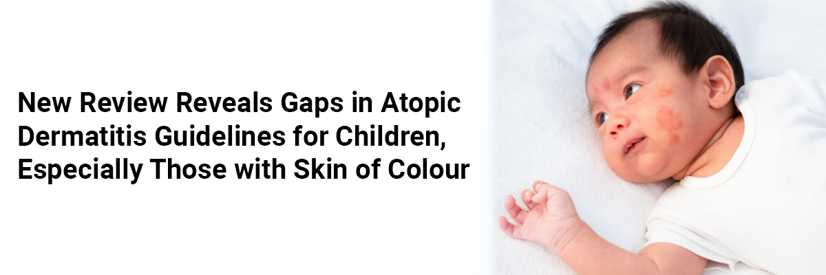 New Review Reveals Gaps in Atopic Dermatitis Guidelines for Children, Especially Those with Skin of Colour