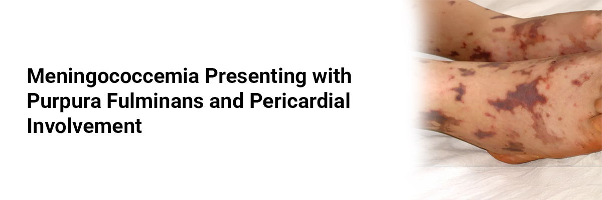 Meningococcemia Presenting with Purpura Fulminans and Pericardial Involvement