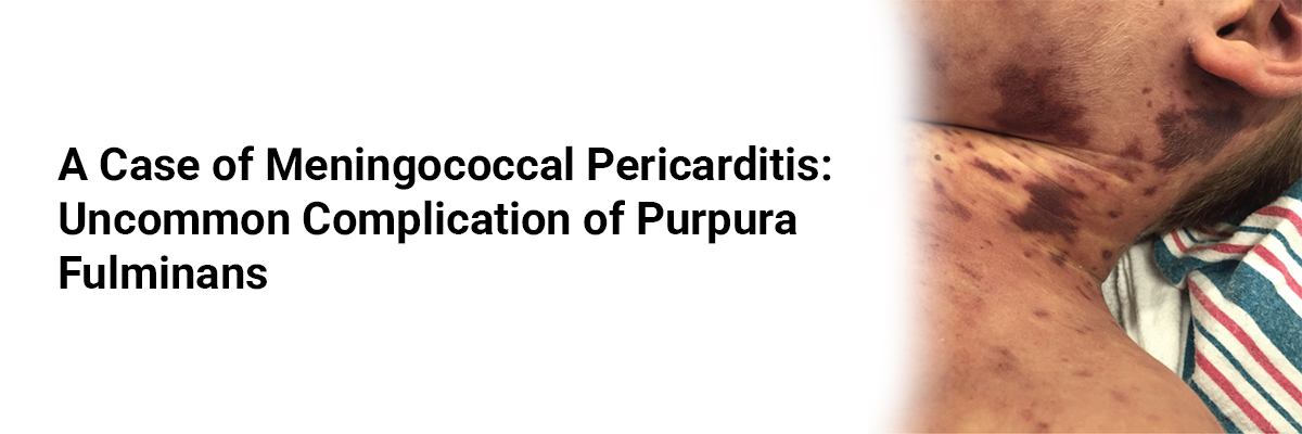 A Case of Meningococcal Pericarditis Uncommon Complication of Purpura Fulminans