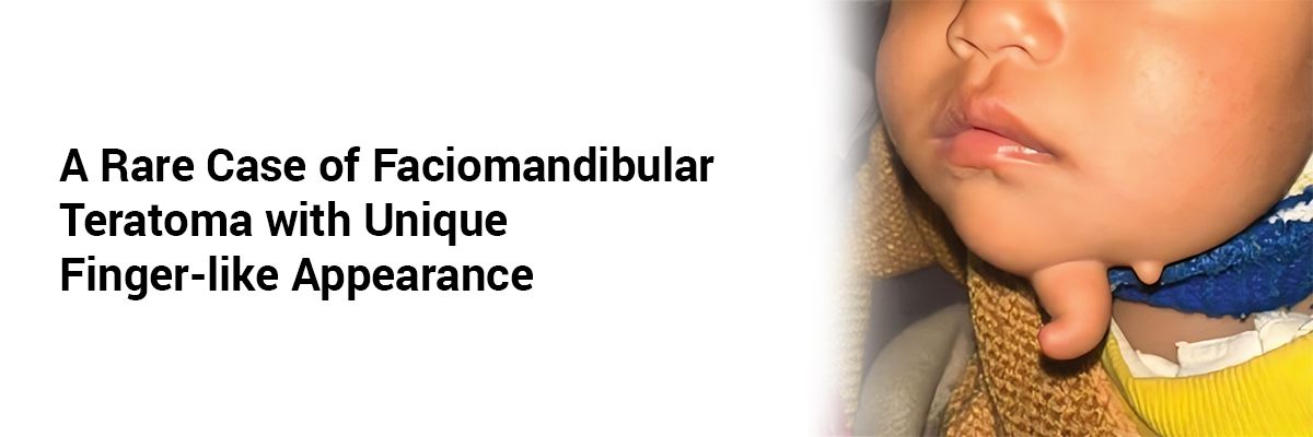 A Rare Case of Faciomandibular Teratoma with Unique Finger-Like Appearance