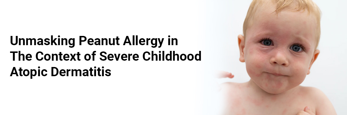  Unmasking Peanut Allergy in the Context of Severe Childhood Atopic Dermatitis
