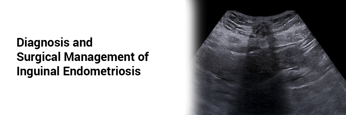 Diagnosis and Surgical Management of Inguinal Endometriosis