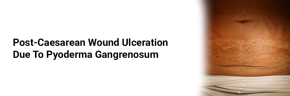 Post-Caesarean Wound Ulceration Due to Pyoderma Gangrenosum