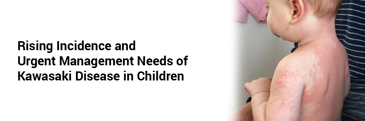 Rising Incidence and Urgent Management Needs of Kawasaki Disease in Children