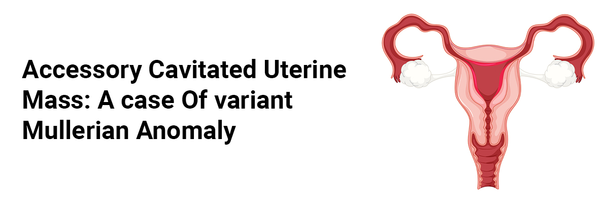 Accessory Cavitated Uterine Mass: A case of variant Mullerian Anomaly