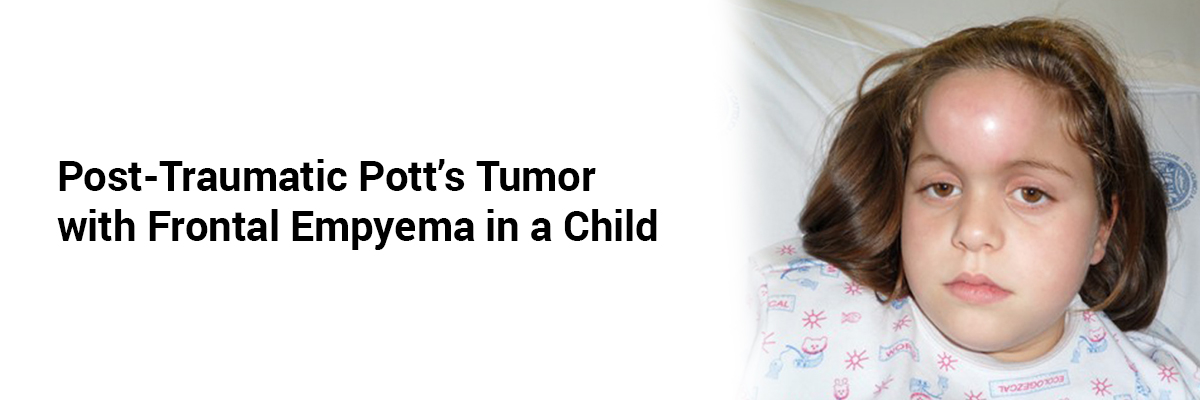 Post-Traumatic Potts Tumor with Frontal Empyema in a Child