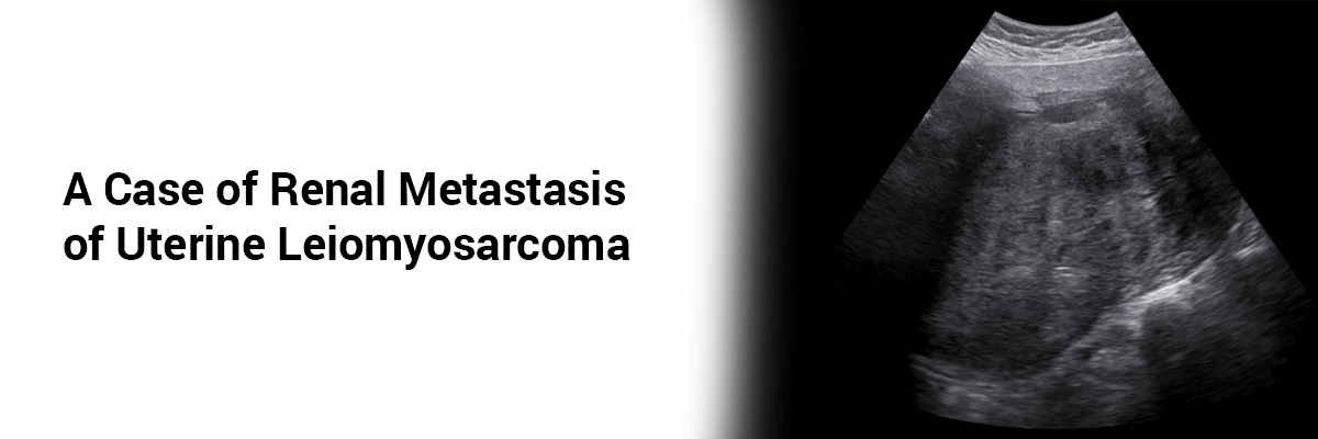 A Case of Renal Metastasis of Uterine Leiomyosarcoma