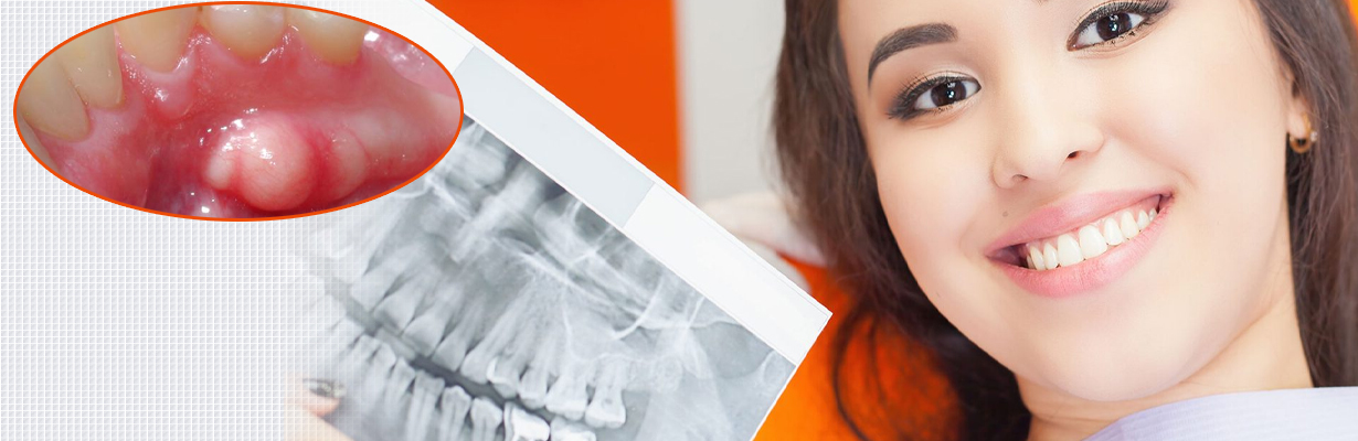 5 year survival rate in oral cancer