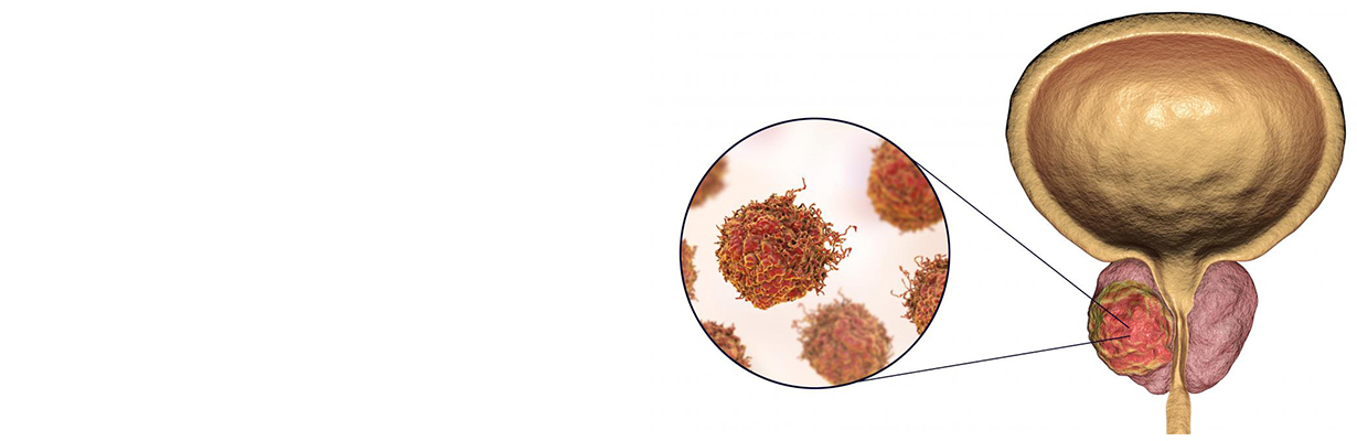 5 year survival rate in prostate cancer