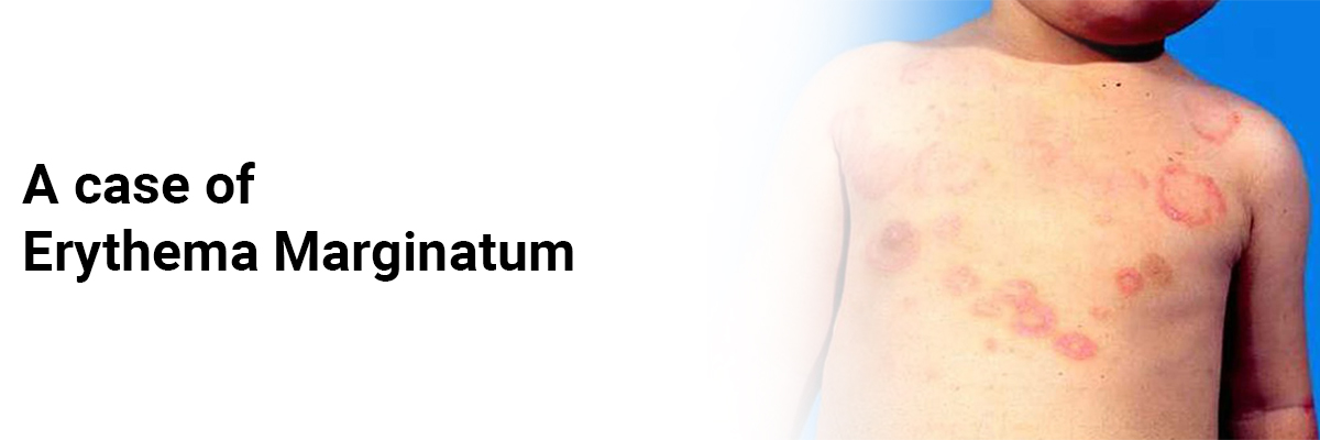 A case of Erythema Marginatum