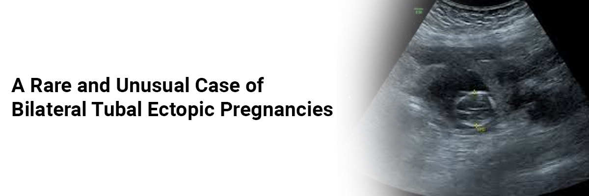 A rare and unusual case of bilateral tubal ectopic pregnancies