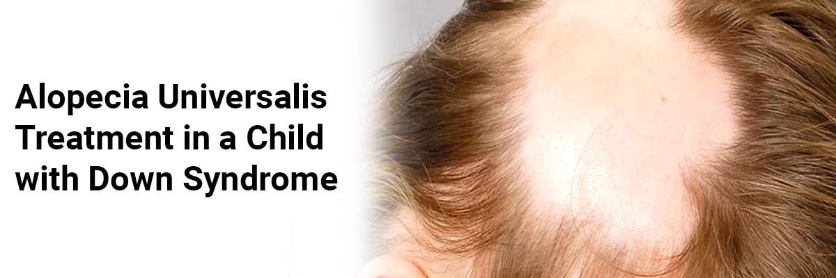 Alopecia Universalis Treatment in a Child with Down Syndrome