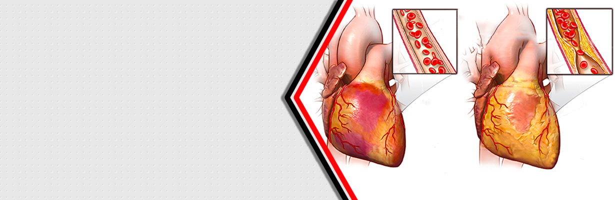 Angina - causes, symptoms and treatment?