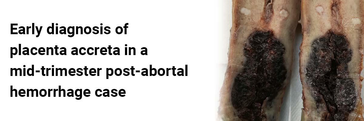 A Rare Case of Allgrove Syndrome