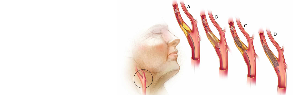Can bypass be done along with carotid artery intervention?